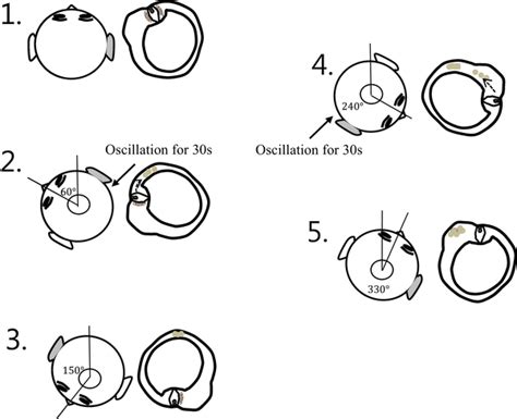 Schematic Of The Modified Cupulolith Repositioning Maneuver Mcurm In