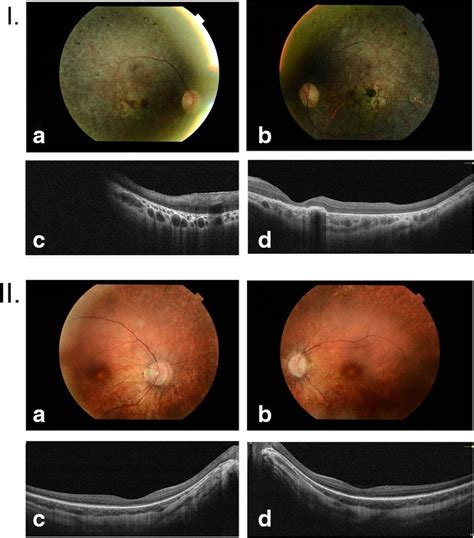 Photographs I Retinal Features Of Patient 6 18 A B Color Fundus