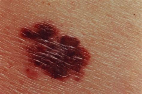 10 Deadly Signs Of Skin Cancer You Need To Spot Early Page 5 Health
