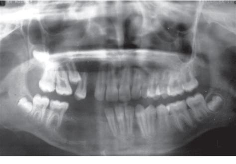 Figure From Nonsyndromic Bilateral Maxillary And Unilateral