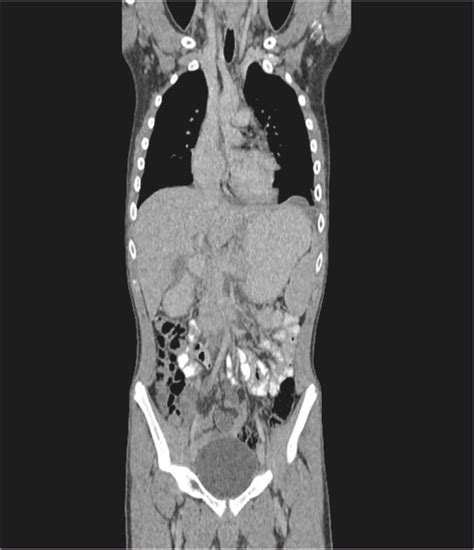 Thorax And Abdomen Ct Scan