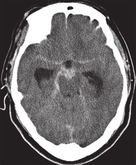 Initial Ct Examination Showing A Subarachnoid Hemorrhage Download