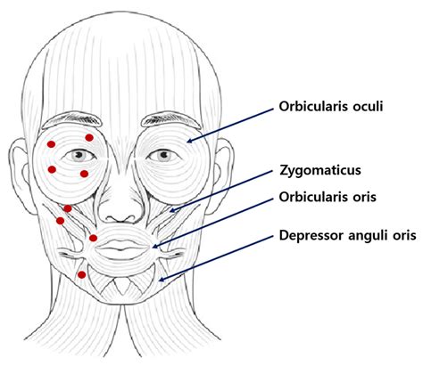 Life Free Full Text Clinical Application Of Botulinum Toxin For