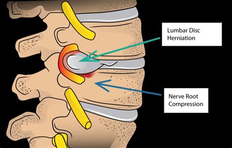 Lumbar Disc Herniation Treatment Los Angeles Beverly Hills Santa