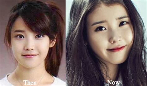 Iu Plastic Surgery Before And After Photos Latest Plastic Surgery Gossip And News Plastic