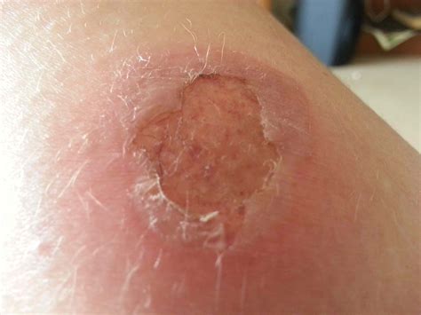 How To Treat A Second Degree Burn Austra Health