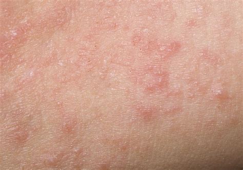 Rash In Groin Area Female Petechial Rash On The Thighs In An