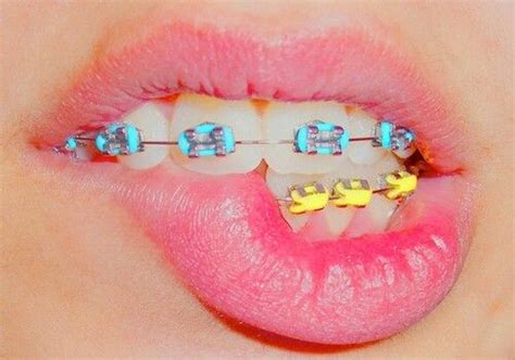 sexy brackets dentistry pinterest dentistas brakets y ortodoncia