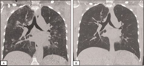 Diagnostic Yield Safety And Advantages Of Ultra Low Dose C Medicine