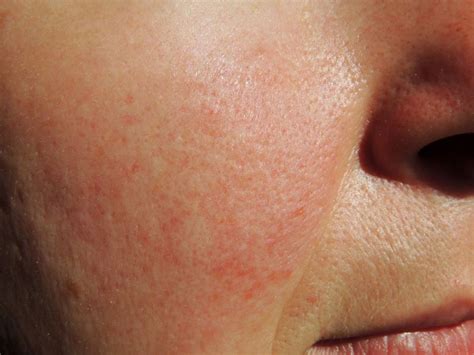 Moderate To Severe Rosacea Associated With Chronic Kidney Disease