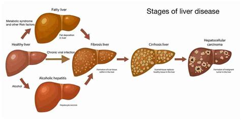 Liver Cirrhosis Symptoms Causes Stages Treatment And Prevention