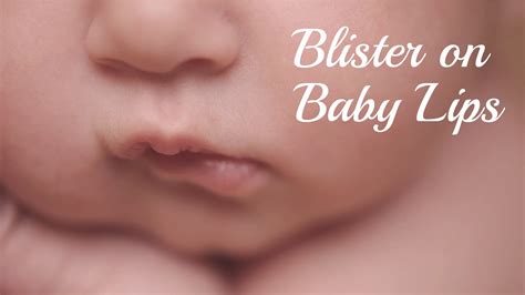 Blister On Baby Lip Its Causes Treatments And More