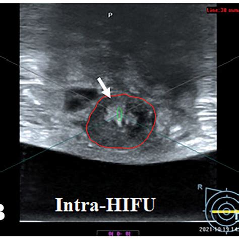 Schematic Diagram Of Hifu Treatment In Patients With Breast