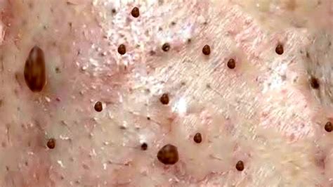 The Most Oddly Satisfying Blackhead Extraction Video Youtube