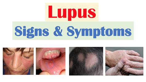 Lupus Signs Symptoms Why They Occur Skin Joints Organ Systems Go IT
