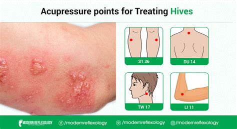 Acupressure Points For Treating Hives Modern Reflexology