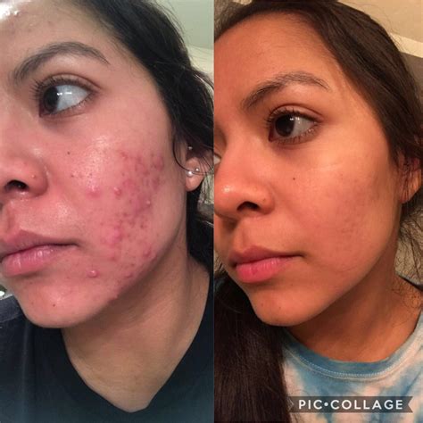 1 Month Before Accutane And 1 Month After Extremely Happy With The