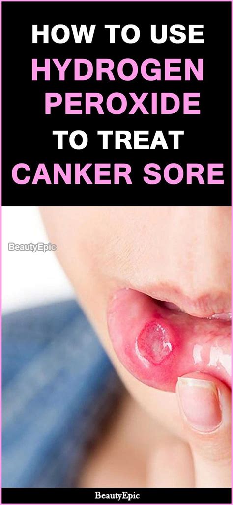 And at the first tingle of a canker. How to Safely Use Hydrogen Peroxide for Canker Sores ...
