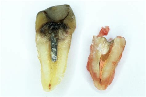 Extracted Premolar Tooth And Root Photograph By Dr Armen Taranyan Science Photo Library