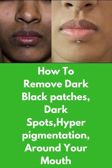 Black Spot On Lower Lip Cancer