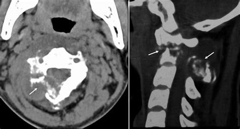 Cervical Tuberculosis Associated With Cervical Pain And Neurologic