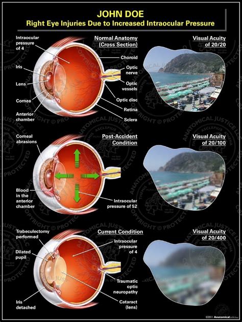 Webmd explains the causes, risk to determine other possible causes for your high eye pressure, an eye doctor (a medical doctor who specializes in eye care and surgery) assesses. Right Eye Injuries Due to Increased Intraocular Pressure