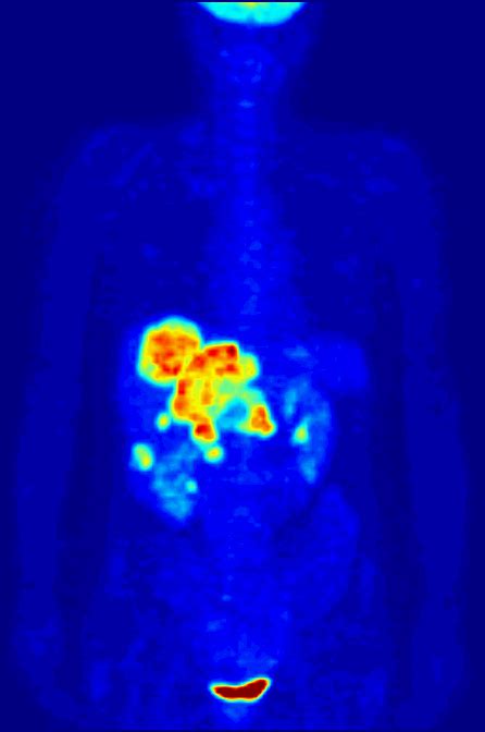 What Is A Pet Scan Definition Uses And Side Effects