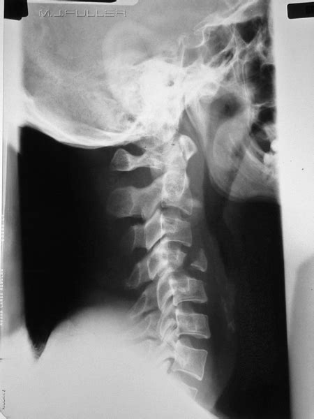 Common Cervical Spine Fractures Wikiradiography