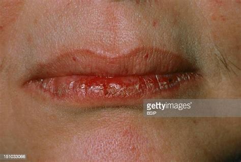 Lichen Planus Photos And Premium High Res Pictures Getty Images