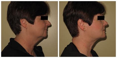 Trim Your Jawline With Lipo Chin Say Goodbye To Double Chin