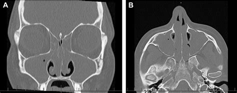 Figure 1 From Eosinophilic Granulomatosis With Polyangiitis Churg