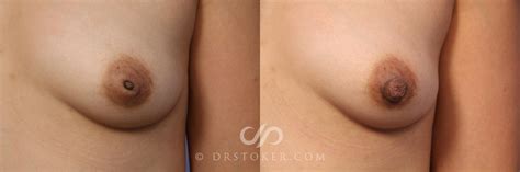 Nipple Inversion Correction Before And After Pictures Case 492 Los