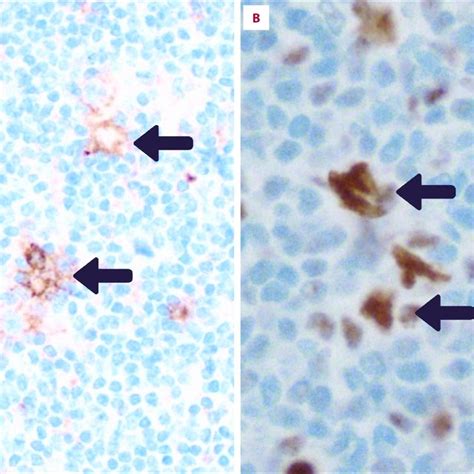 Photomicrographs Of The Histopathology Of The Axillary Lymph Node In A