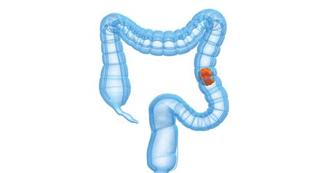 Approximately 41,000 people develop the disease every year. Bowel cancer - Introduction