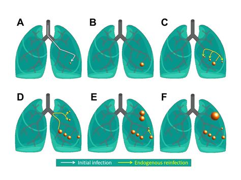 Virtual Lungs To Understand The Dynamics Of Tuberculosis Lesions Within