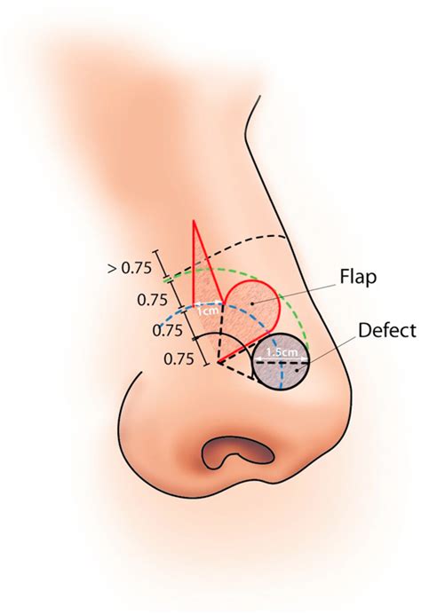 Figure From Reconstruction Of Nasal Tip And Columella Semantic Scholar