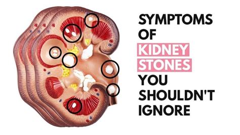 What Happens If You Have Kidney Stones