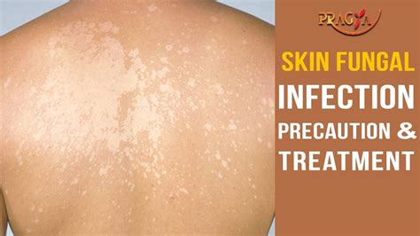 Watch Skin Fungal Infection Precaution And Treatment Youtube