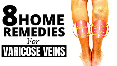 8 Home Remedies For Varicose Veins Youtube