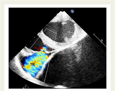 Transthoracic Echocardiography Apical Four Chamber View Showing Severe