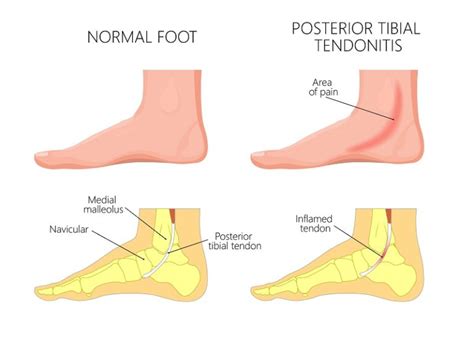 Posterior Tibial Tendonitis Posterior Tibial Tendon Dysfunction