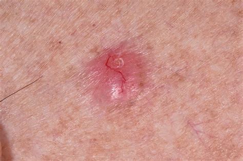 What Does Skin Cancer Look Like Basal Cell Carcinoma My Xxx Hot Girl