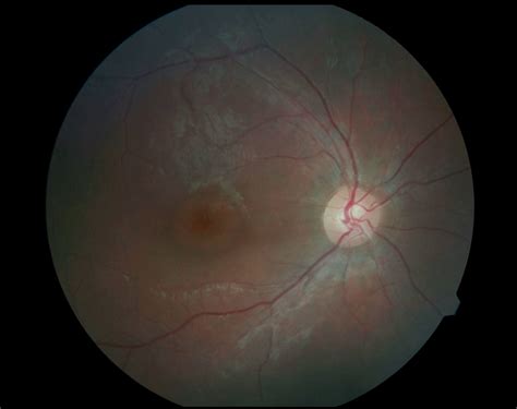 Moran Core Cln3 Associated Retinal Degeneration