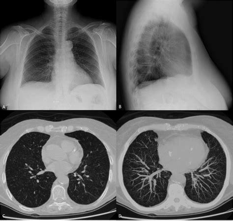 Diagnostic Accuracy Of Chest Radiography For The Diagnosis Of