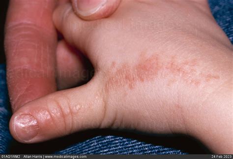 Stock Image Dermatology Lichen Striatus Small Red Bumps Following A