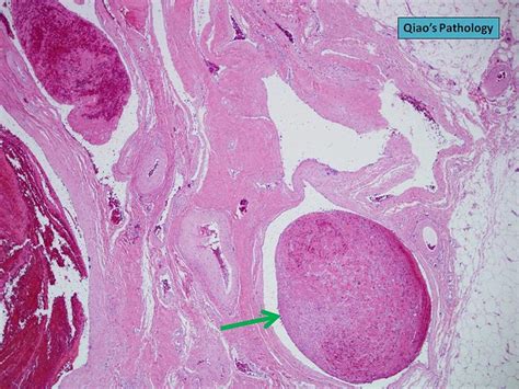 Qiaos Pathology Subcutaneous Venous Hemangioma With Thrombosis A