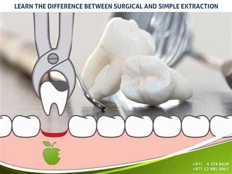 Learn The Difference Between Surgical And Simple Extraction American
