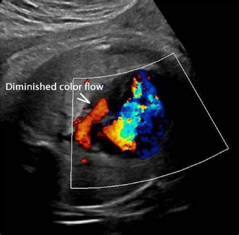 Prenatal Finding Of Foramen Ovale Aneurysm Causing Mitral Valve