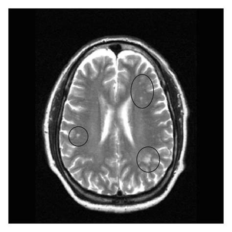 Mri Image Of The Brain In An Axial View Showing The “pre Contrast T2