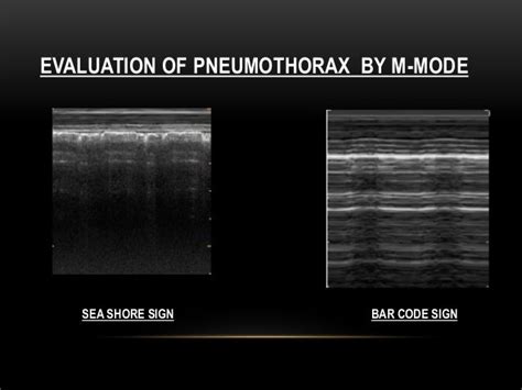 Sonographic Features Of Pneumothorax Dr Suresh